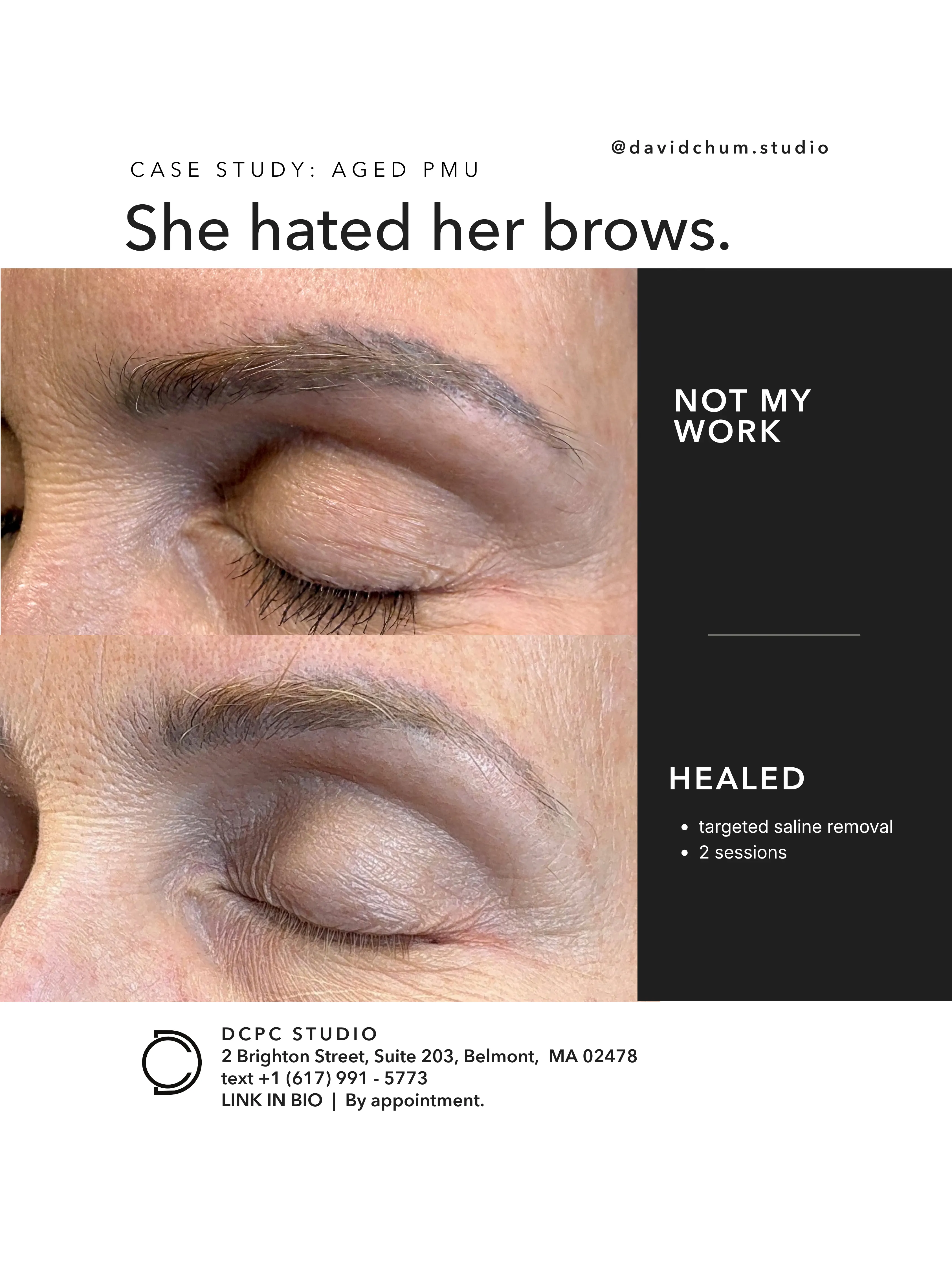 Case study: aged PMU. She hated her brows. Not my work, above; healed, below, after targeted saline removal, 2 sessions.