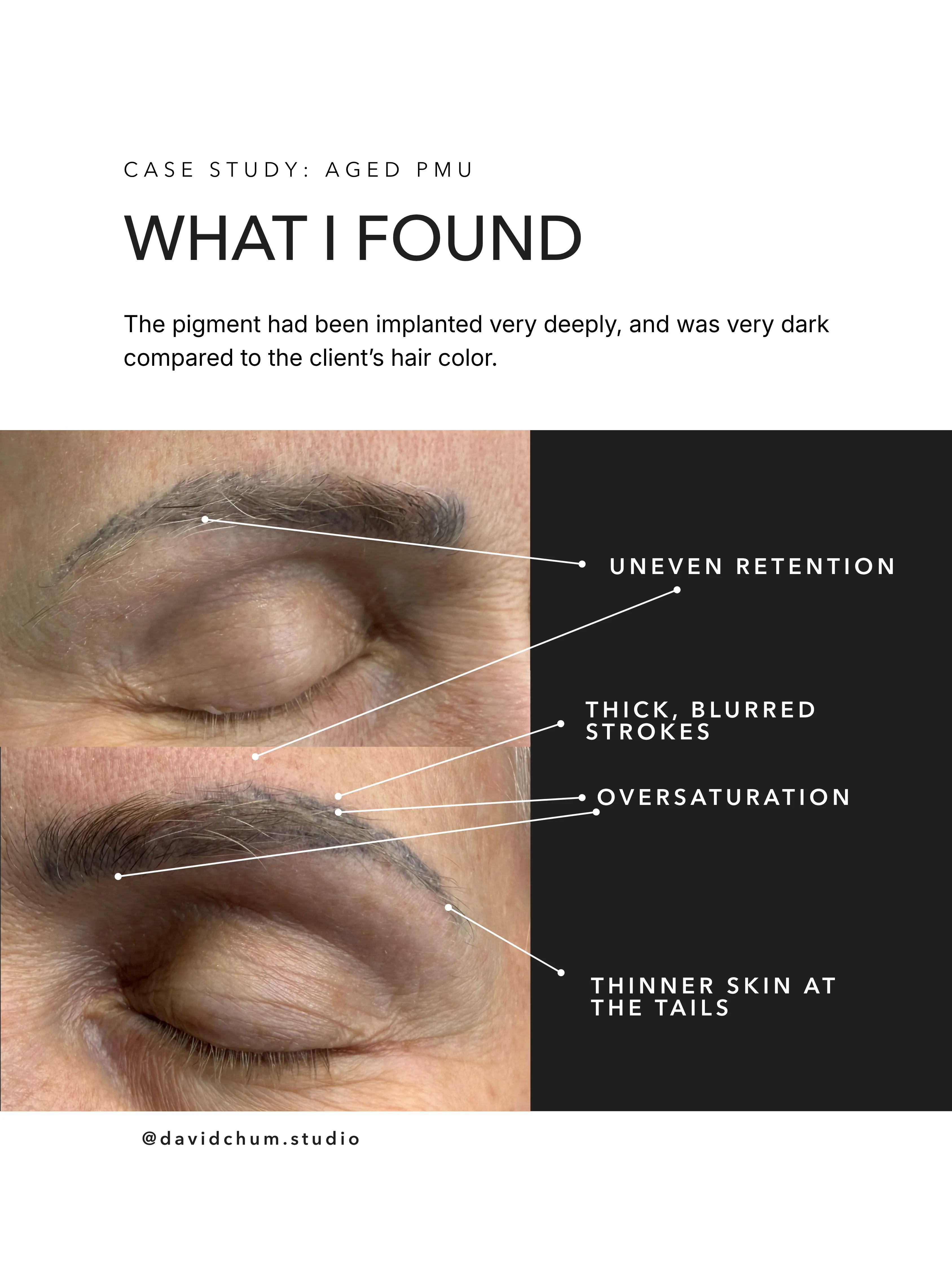 What I found: the pigment had been implanted very deeply, and was very dark compared to the client's hair color. Uneven retention; thick, blurred strokes; oversaturation; thinner skin at the tails.