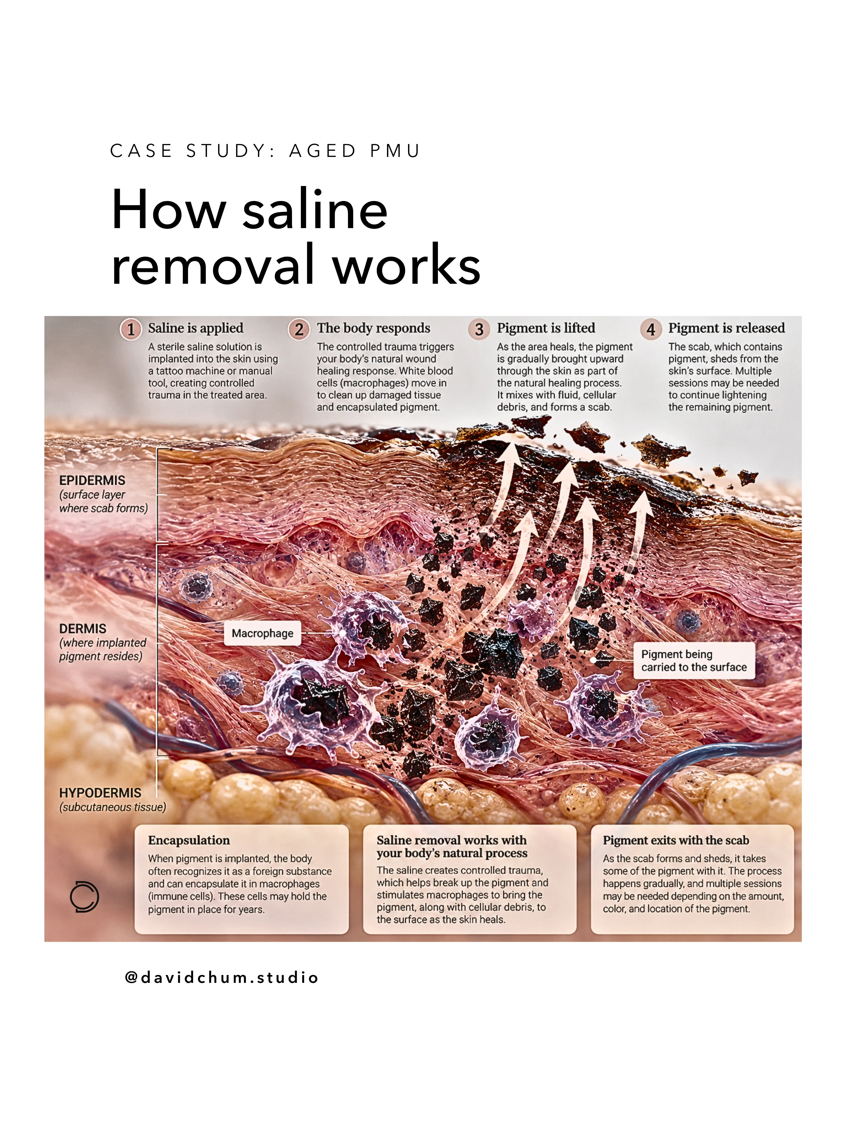 How saline removal works: saline is applied, the body responds, pigment is lifted, pigment is released with the scab.
