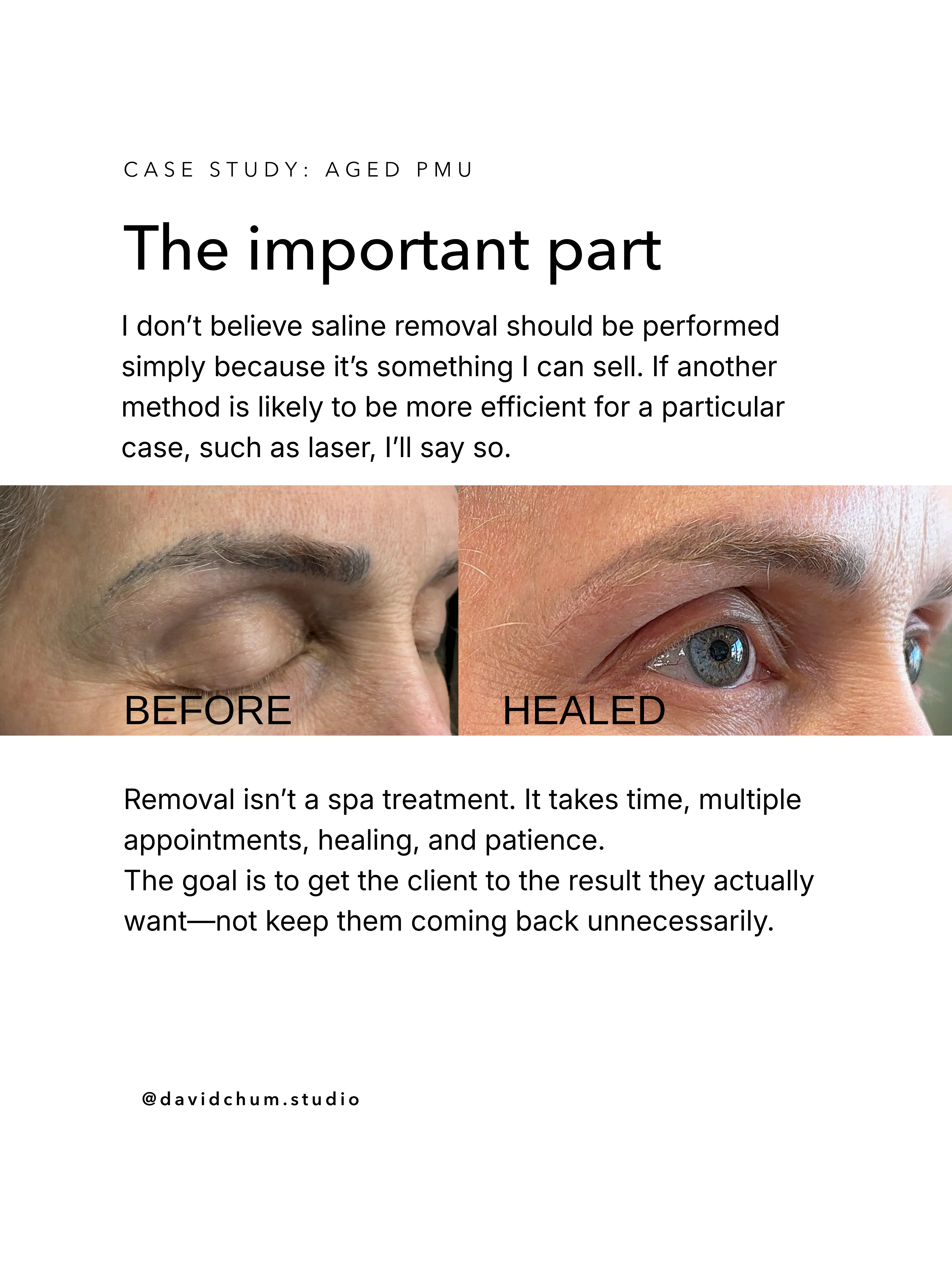 The important part. I don't believe saline removal should be performed simply because it's something I can sell. If another method is likely to be more efficient for a particular case, such as laser, I'll say so. Before and healed.